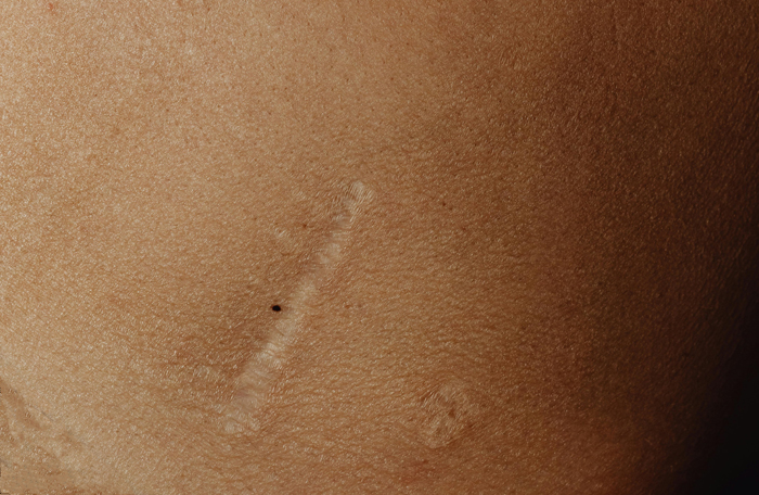 【萊沃醫(yī)療：知識分享】不想疤痕增生，這幾件事你一定要注意