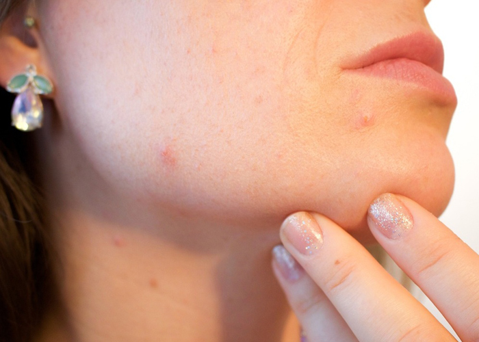 【萊沃醫(yī)療：知識分享】為什么到了冬天，臉上還是愛起痘痘？